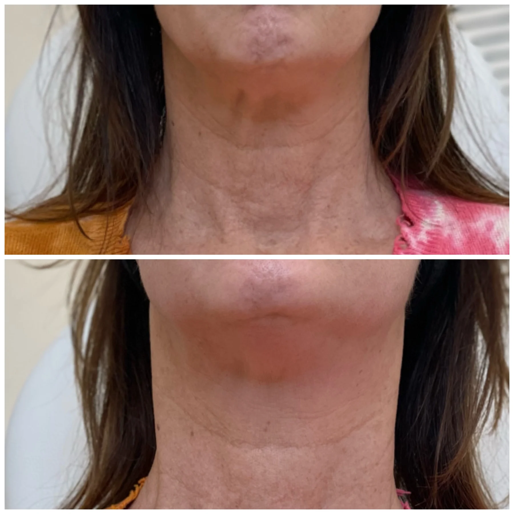 Youthologymedical_Gallery_PDO_Thread_Neck_Lift_Image_One_In_Melville_NY