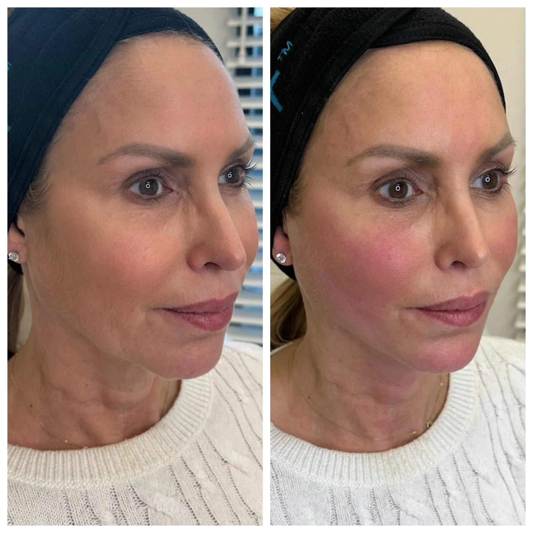 Youthologymedical_Gallery_PDO_Threads_Mid_and_Lower_Face_Image_Two_In_Melville_NY