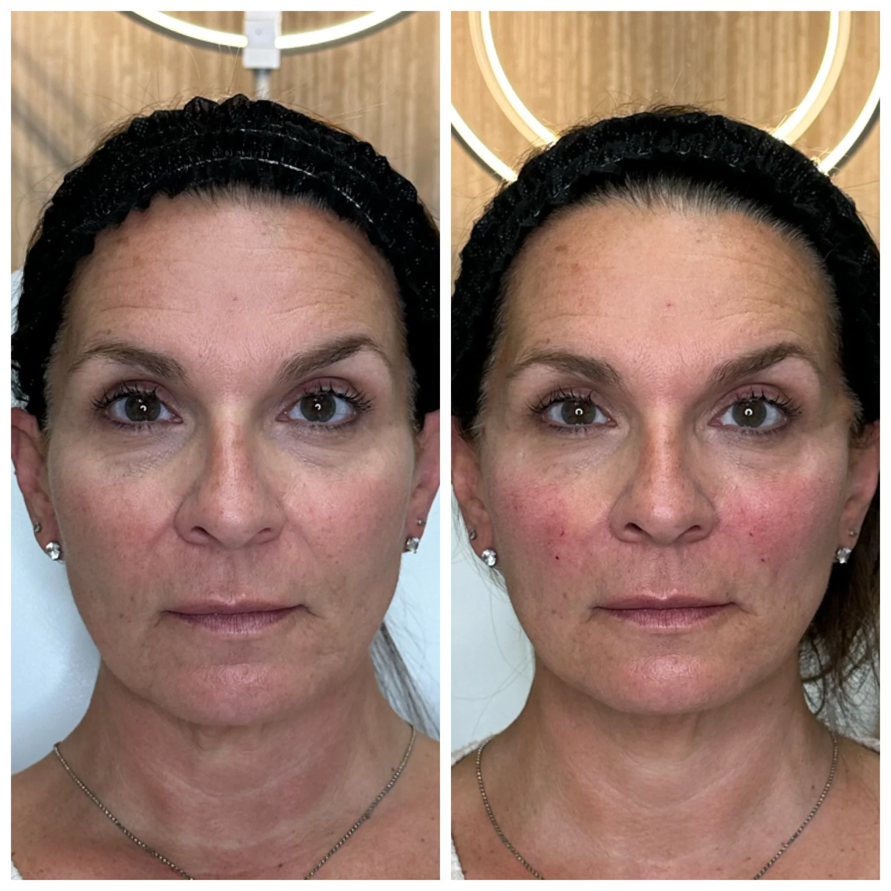 Youthologymedical_Gallery_PDO_Threads_Midface_Lift_Image_Four_In_Melville_NY