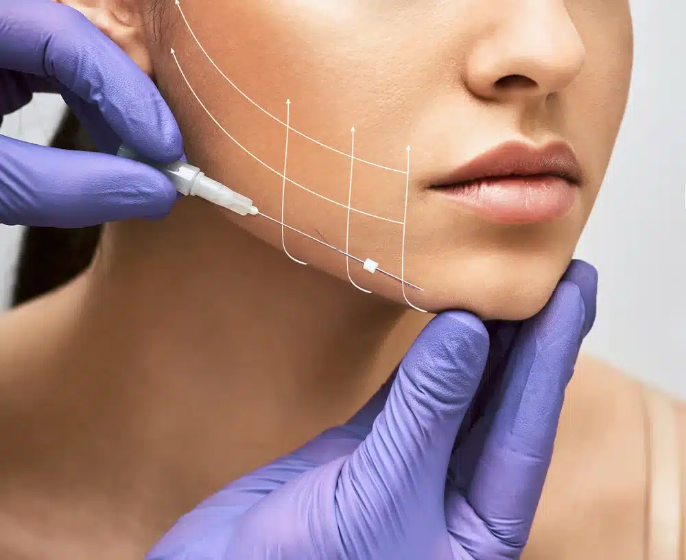 Youthologymedical_Blog_Mint_PDO_Thread_Facelift_In_Melville_NY