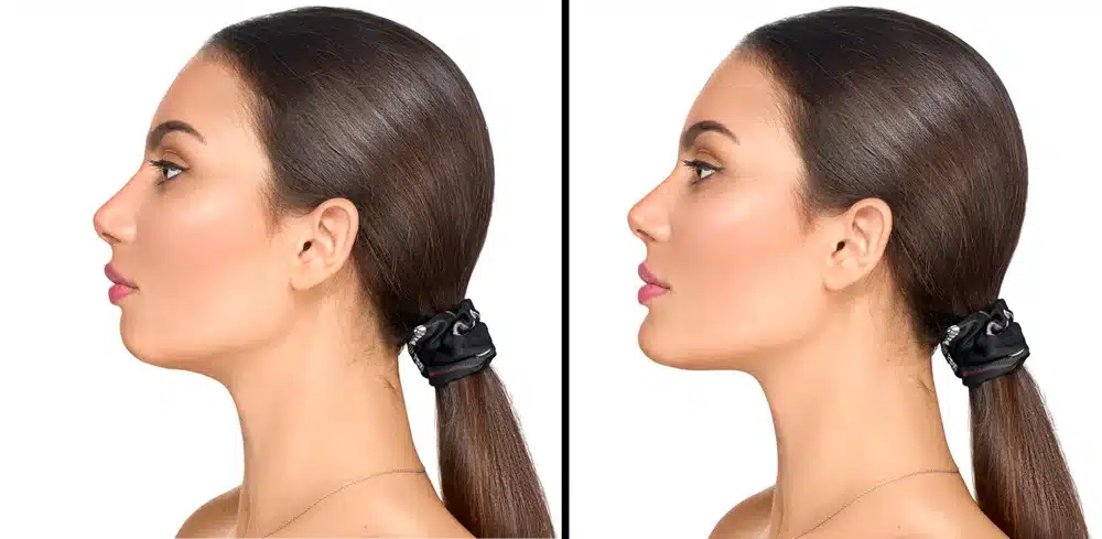 Youthologymedical_Blog_kybella_Cin_Reduction_In_Melville_NY