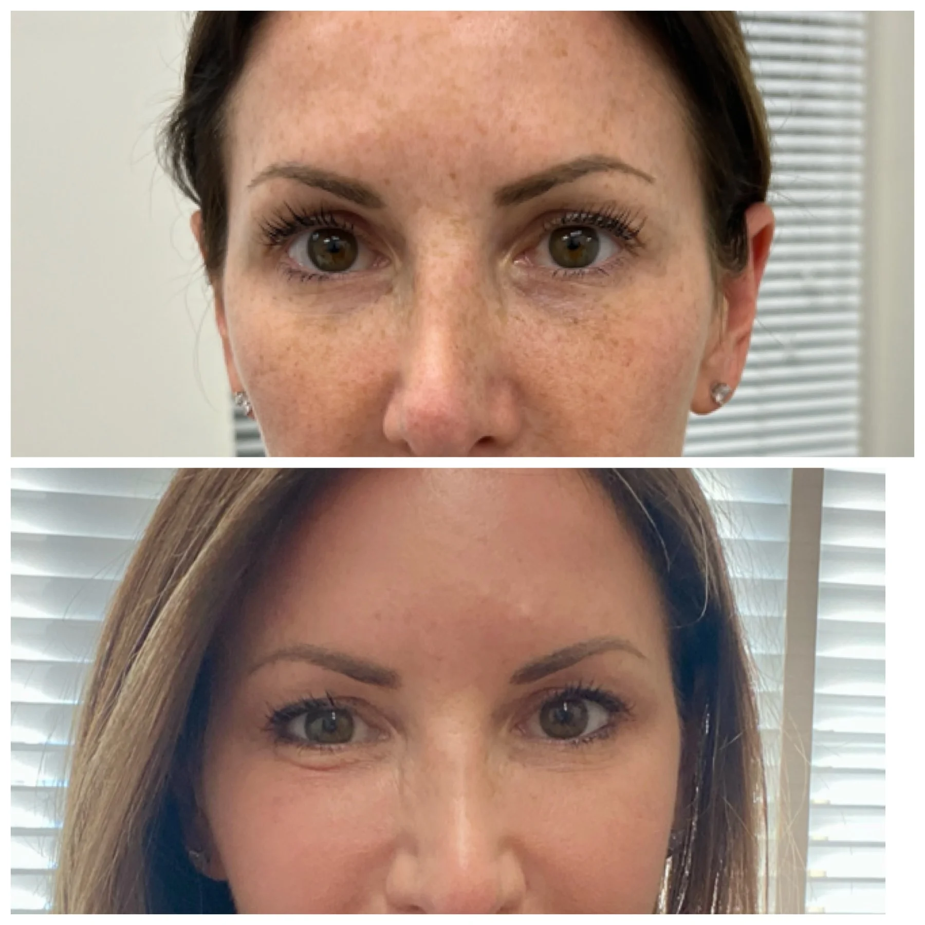 Youthologymedical_Gallery_BBL_and_Moxi_Image_One_In_Melville_NY
