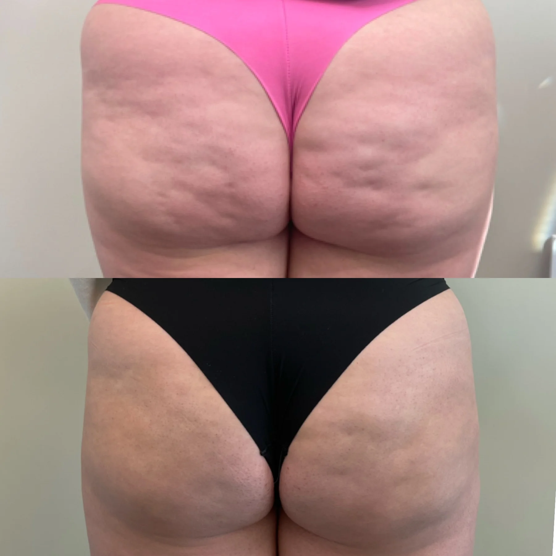 Youthologymedical_Gallery_Cellulite_Treatment_Image_One_In_Melville_NY