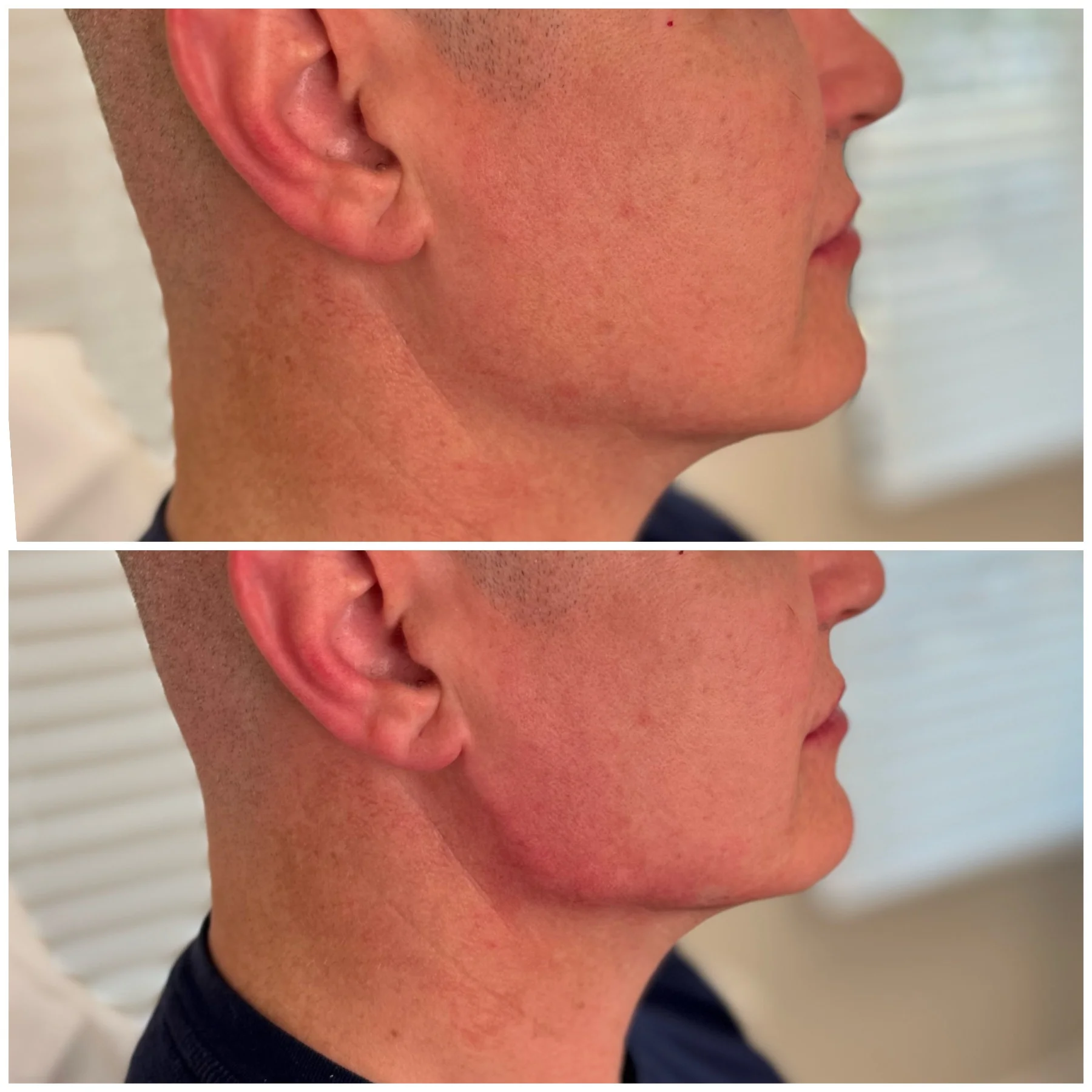 Youthologymedical_Gallery_Jaw_Angle_Filler_Image_Two_In_Melville_NY