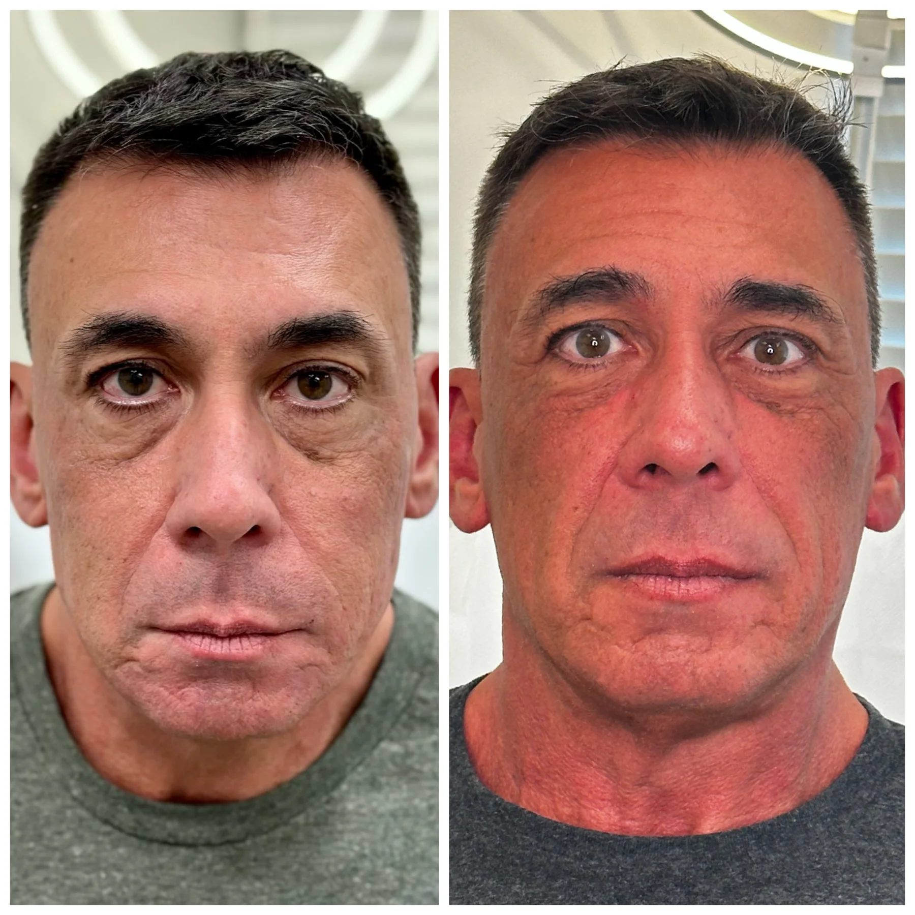 Youthologymedical_Gallery_Sculptra_Image_One_In_Melville_NY