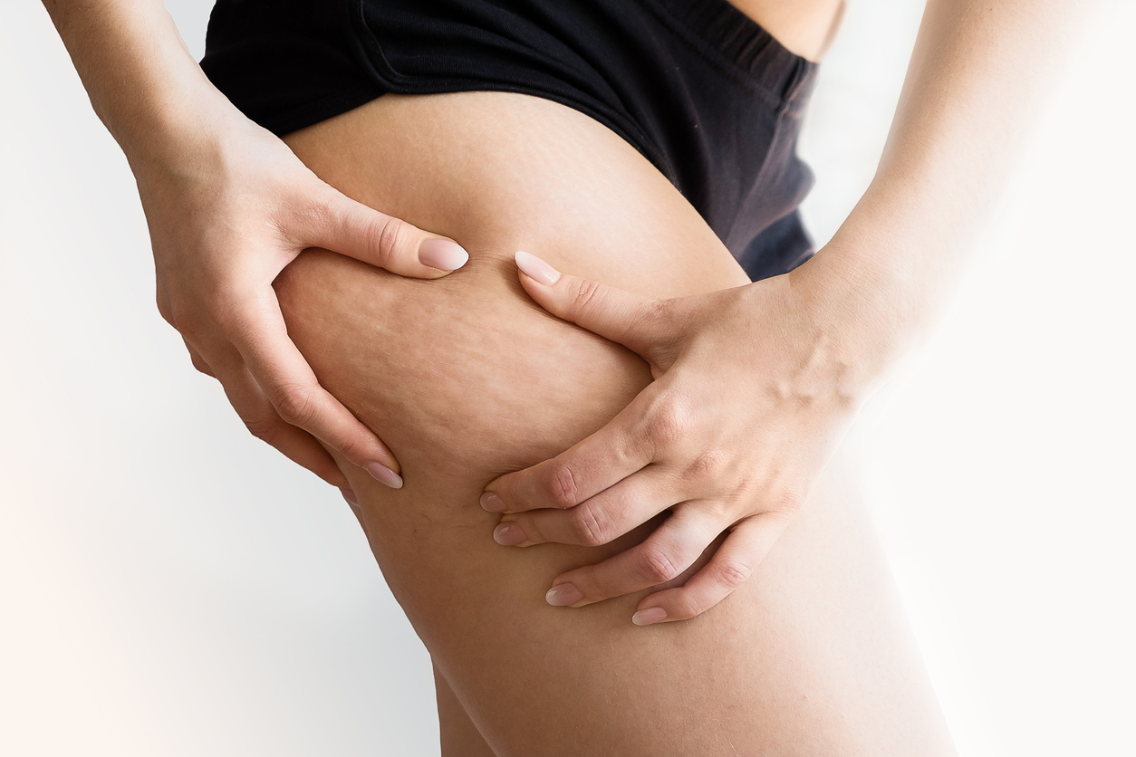A close-up shot of cellulite on a woman's thigh