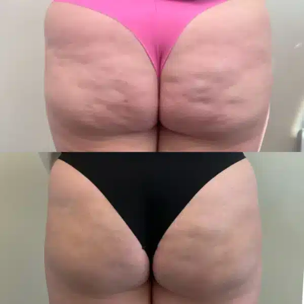 Before and After Image: Cellulite - back