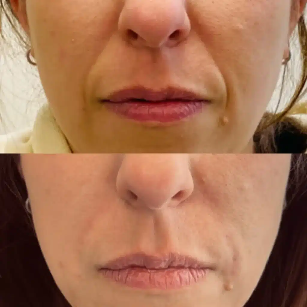Before and After Image: Nasolabial Fold Filler - front