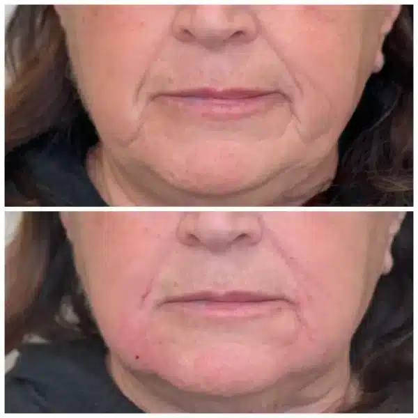 Before and After Image: Nasolabial Folds and Marionette Lines - front
