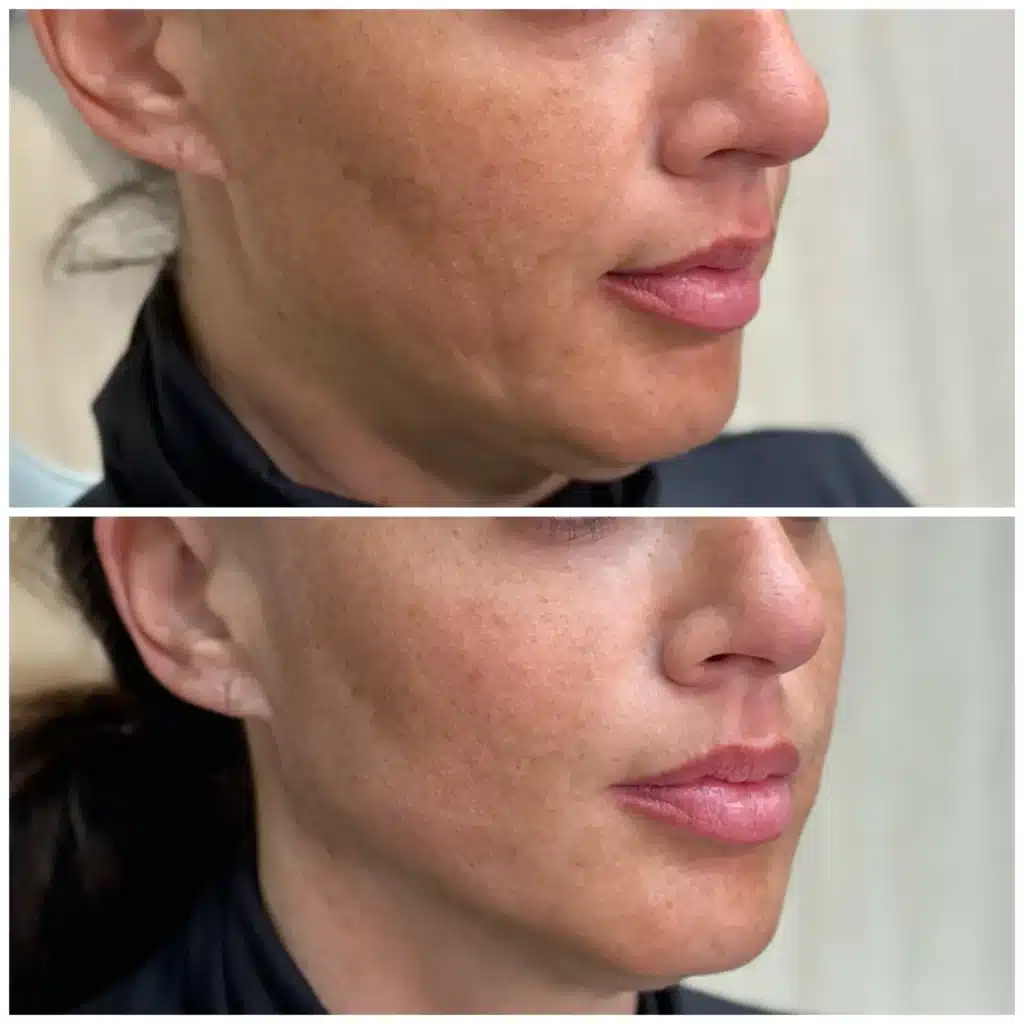 Before and After Image: PDO Thread Lower Face / Jawline - right-front-oblique