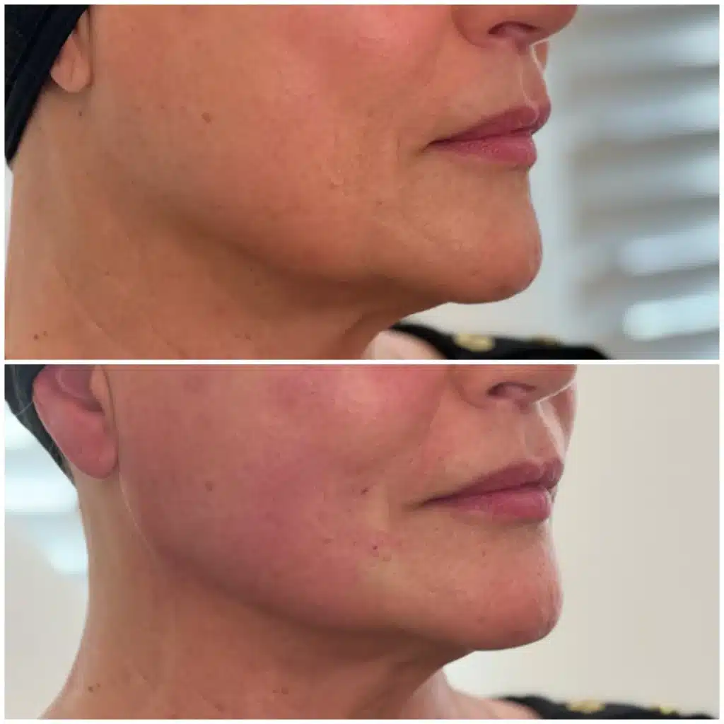 Before and After Image: PDO Thread Lower Face / Jawline - right-front-oblique