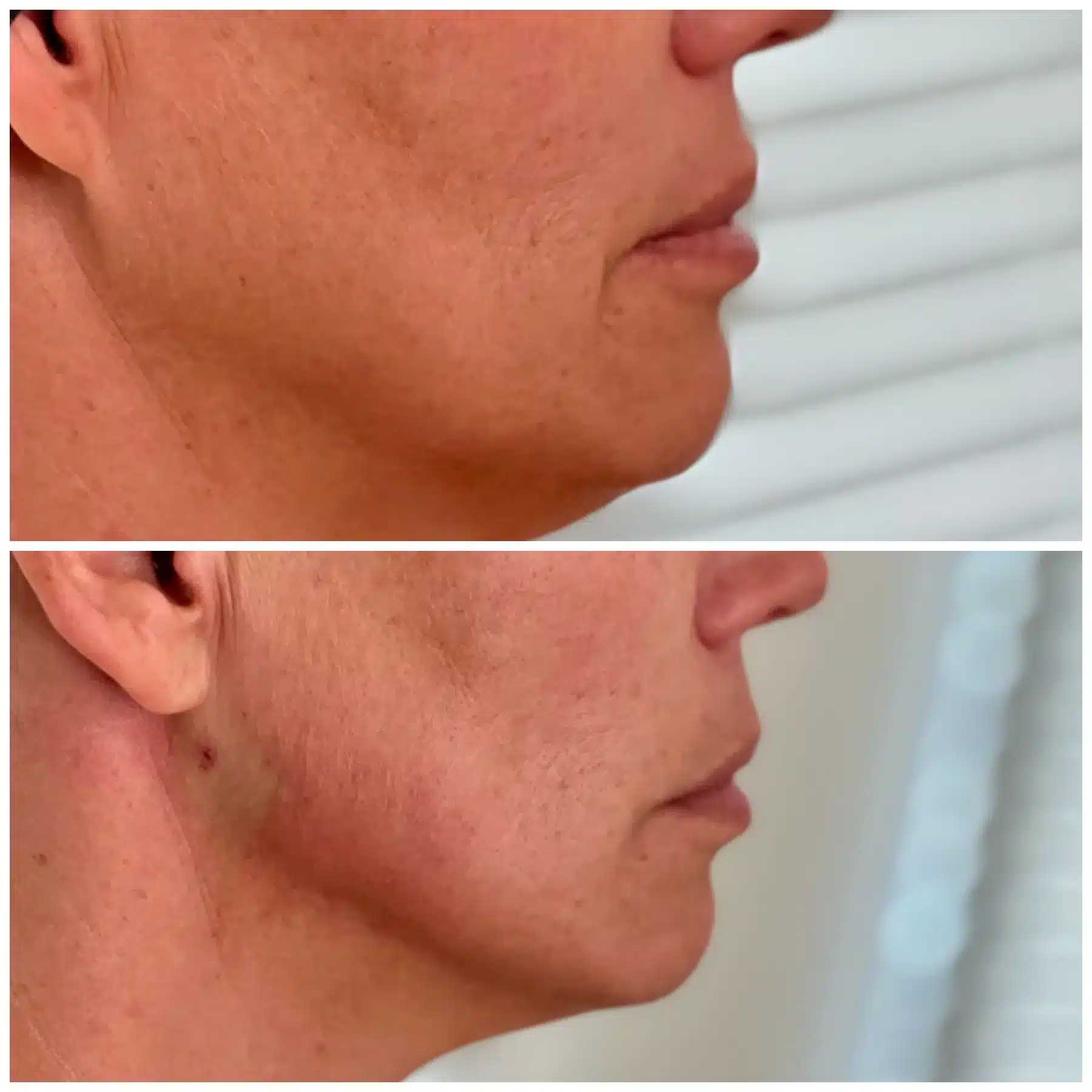 Before and After Image: PDO Thread Lower Face / Jawline - right-side