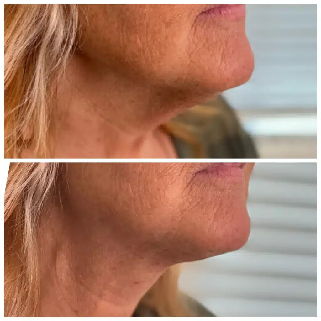 Before and After Image: PDO Thread Neck Lift - right-front-oblique