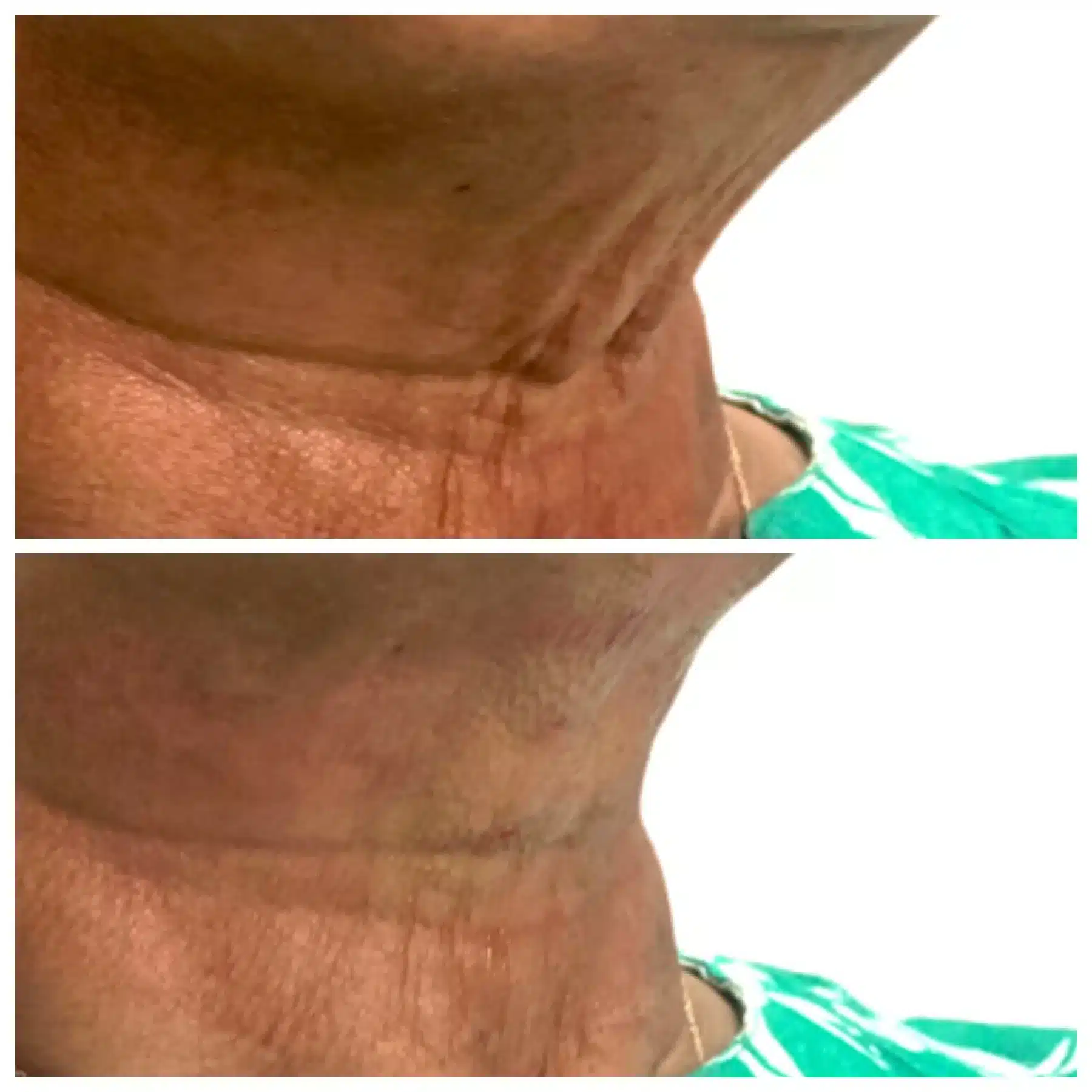 Before and After Image: PDO Thread Neck Lift - right-front-oblique