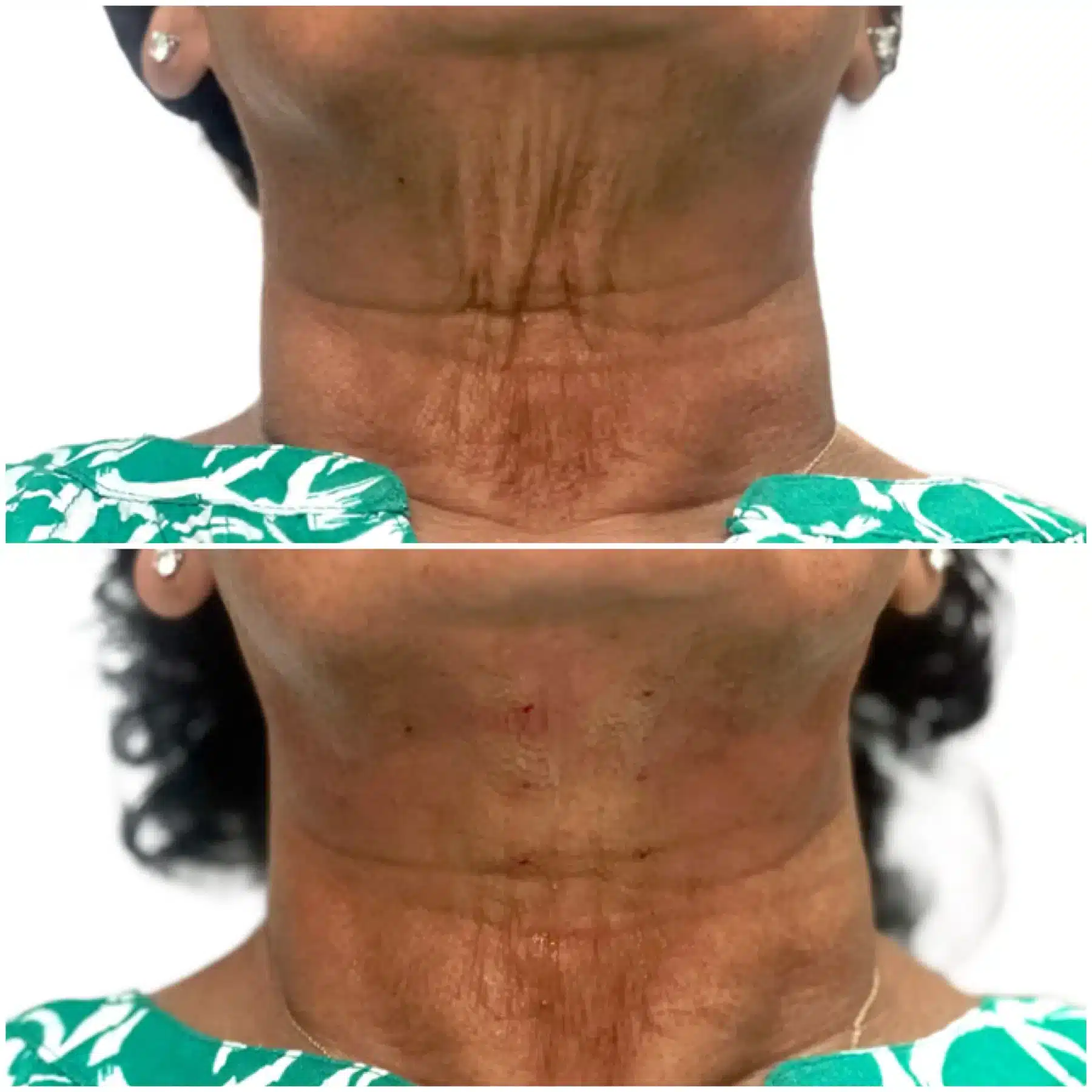 Before and After Image: PDO Thread Neck Lift - right-front-oblique