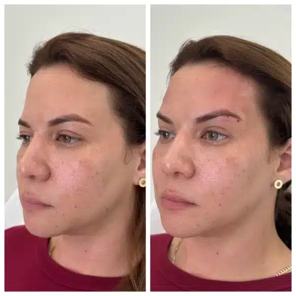 Before and After Image: PDO Threads Brow Lift - front