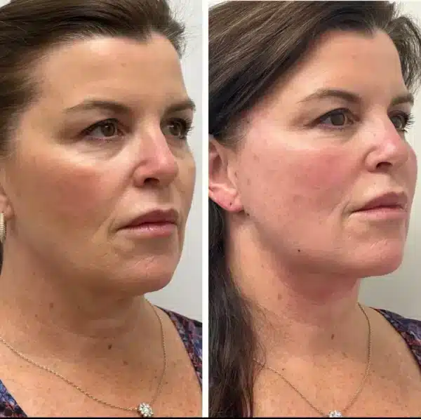 Before and After Image: PDO Threads Mid and Lower Face - right-front-oblique