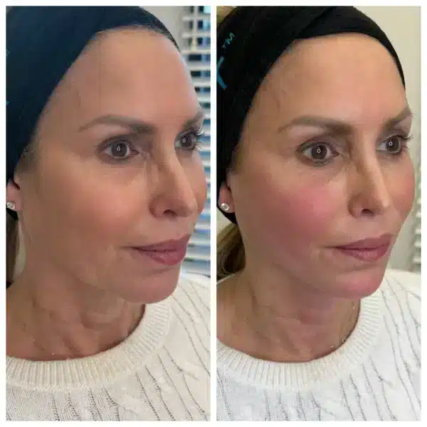 Before and After Image: PDO Threads Mid and Lower Face - right-front-oblique