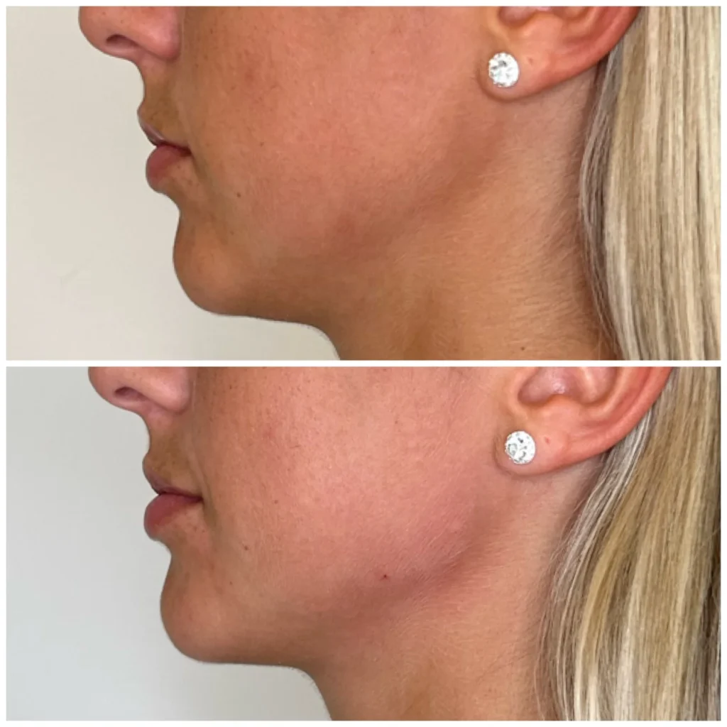 Before and After Image: Chin and Jawline Filler - left-side