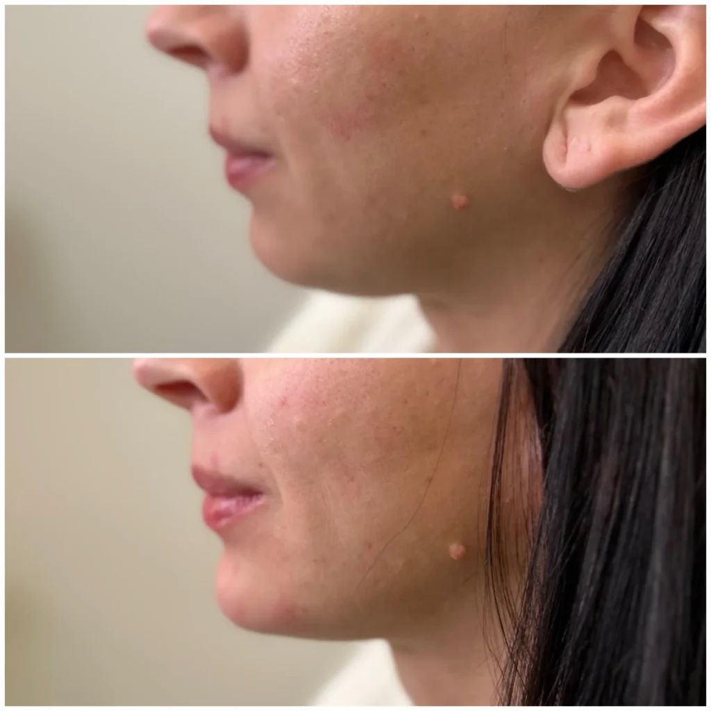 Before and After Image: Chin and Jawline Filler - left-side