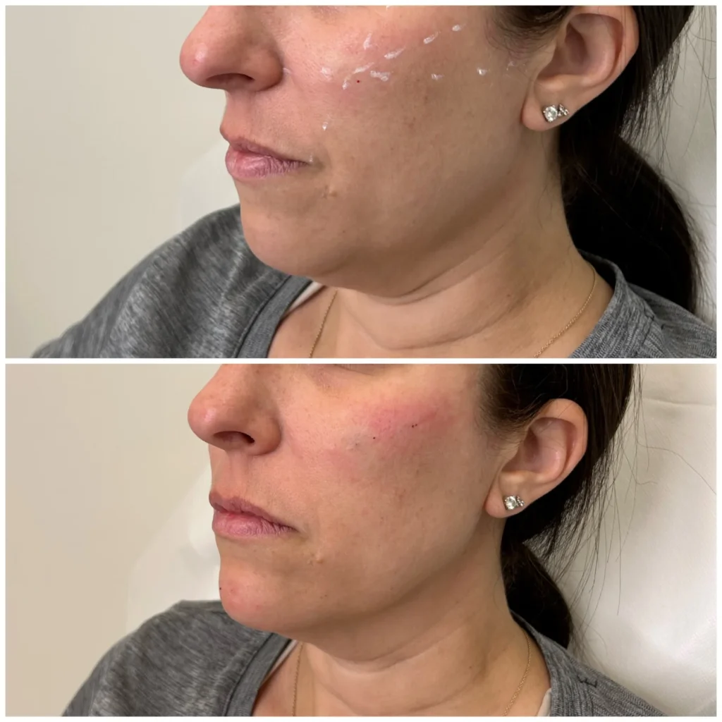 Before and After Image: Chin and Jawline Filler - left-front-oblique