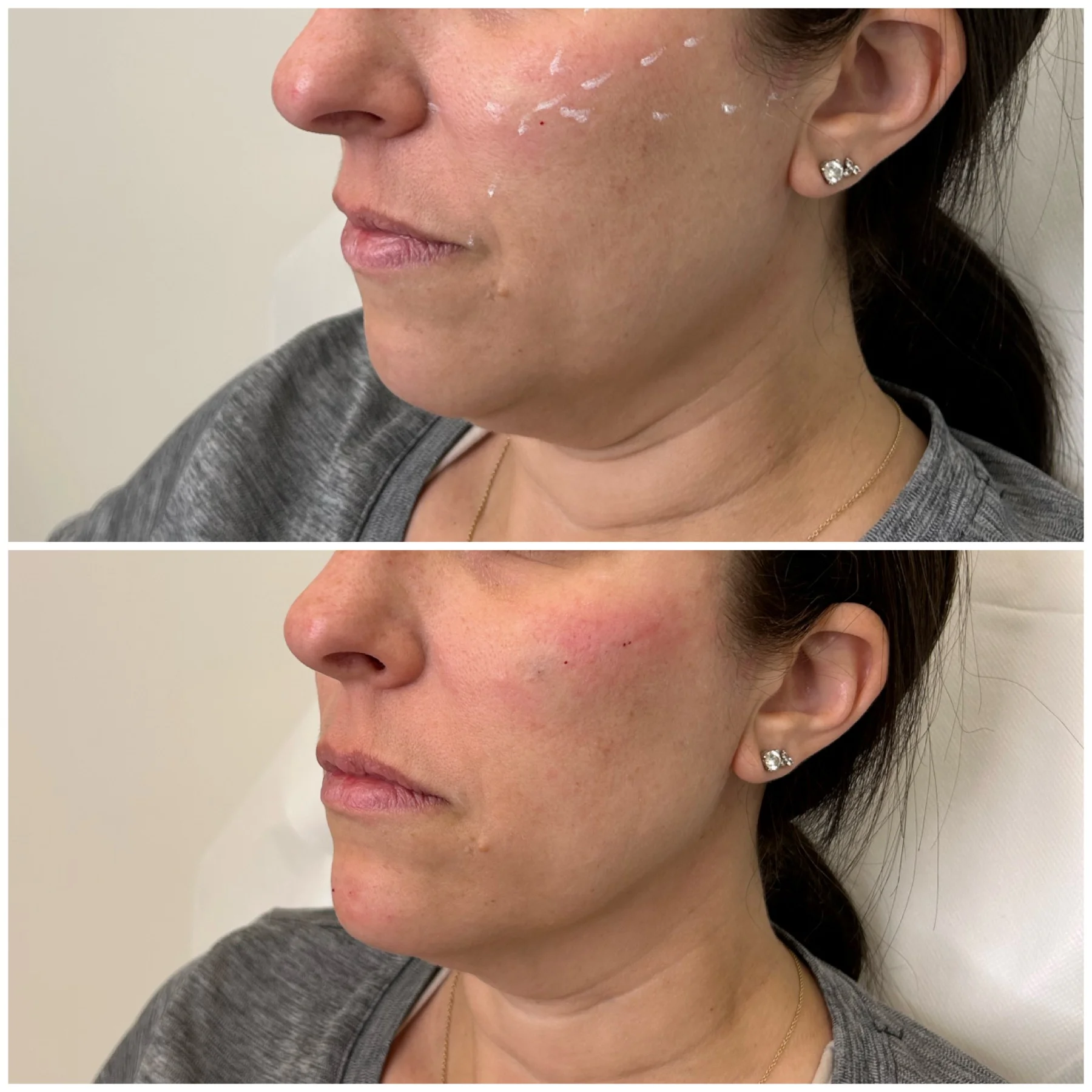 Before and After Image: Chin and Jawline Filler - left-front-oblique