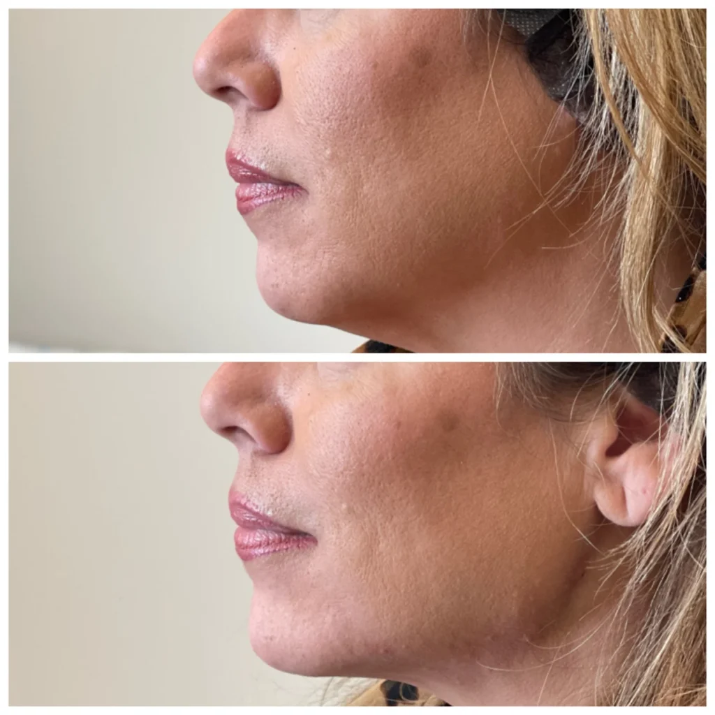 Before and After Image: Chin and Jawline Filler - left-side