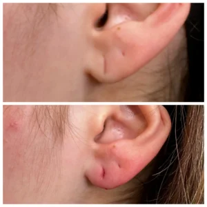 Before and After Image: Earring Hole Filler - left-front-oblique