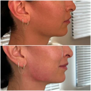 Before and After Image: Jaw Angle Filler - right-side