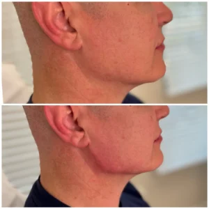 Before and After Image: Jaw Angle Filler - right-side