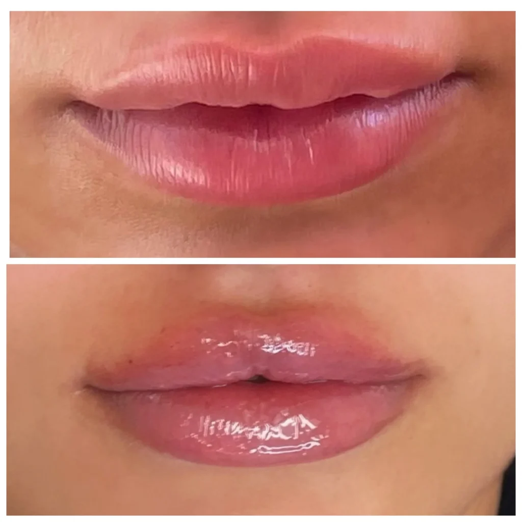 Before and After Image: Lip Filler - front