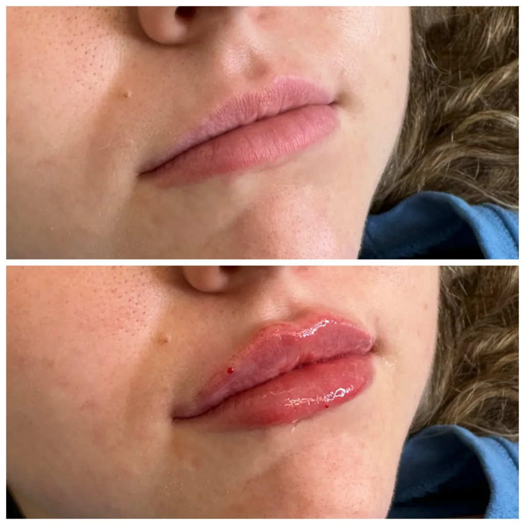 Before and After Image: Lip Filler - right-front-oblique