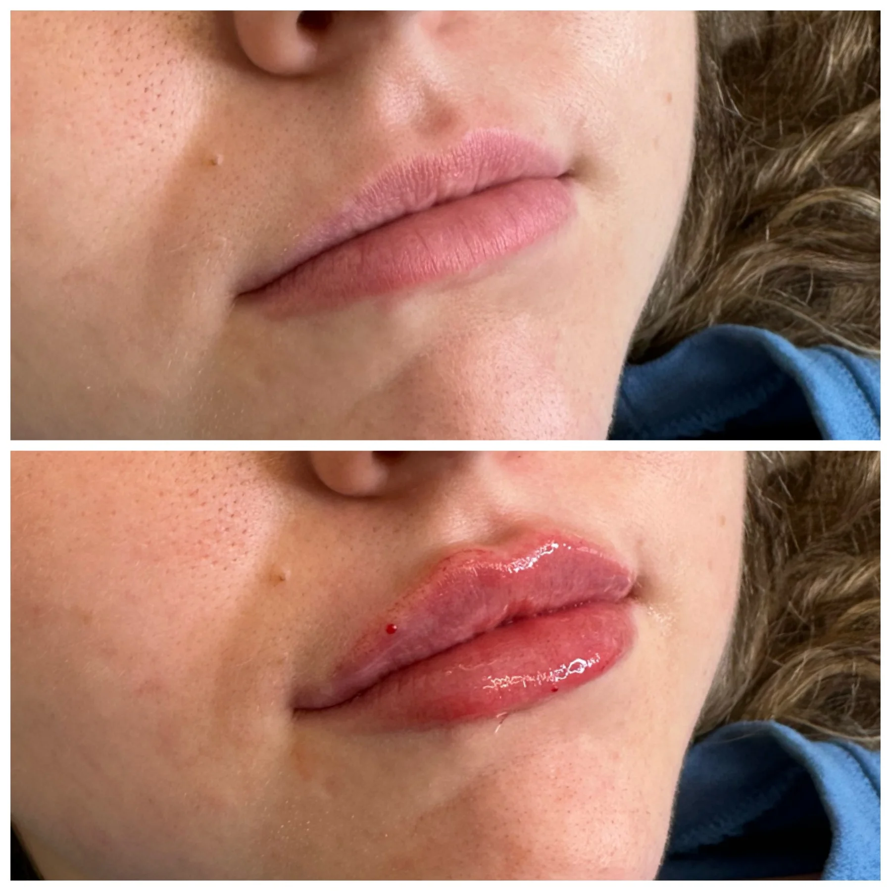 Before and After Image: Lip Filler - right-front-oblique