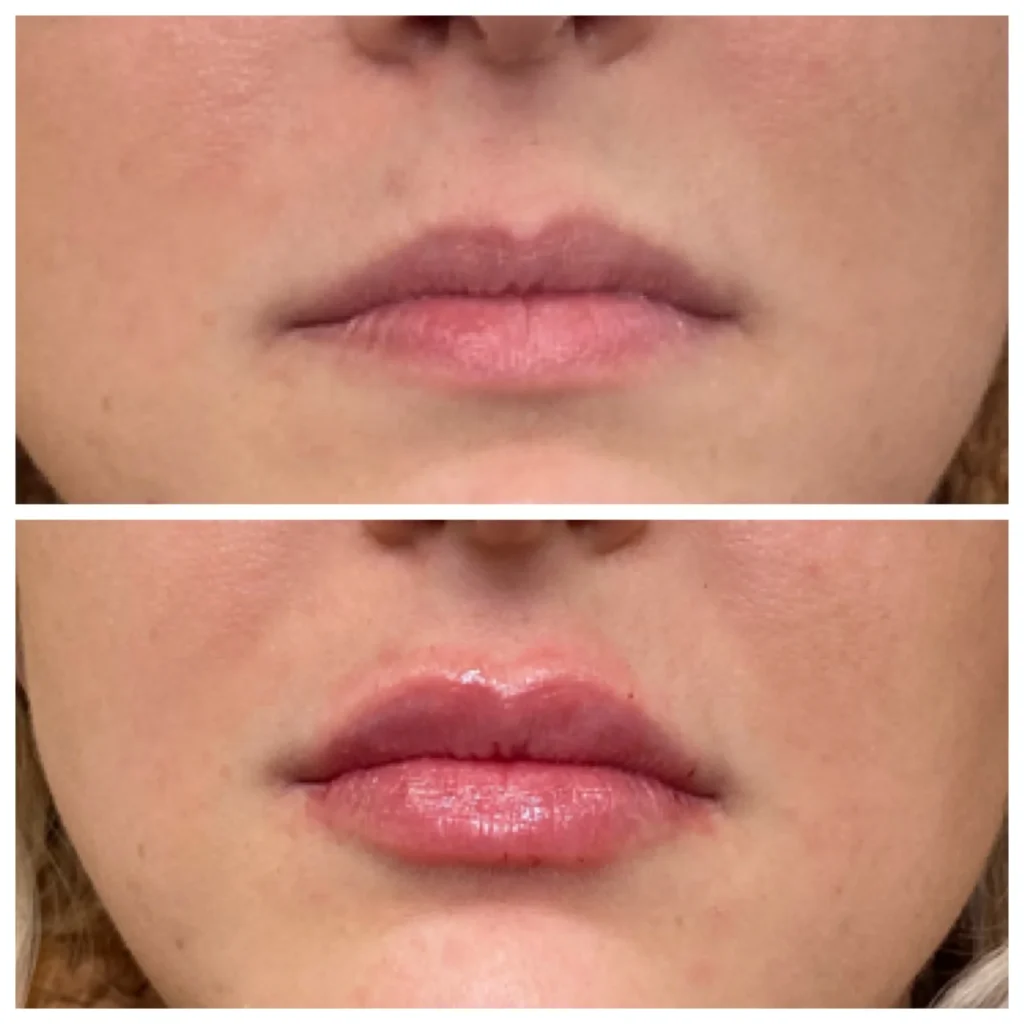 Before and After Image: Lip Filler - front