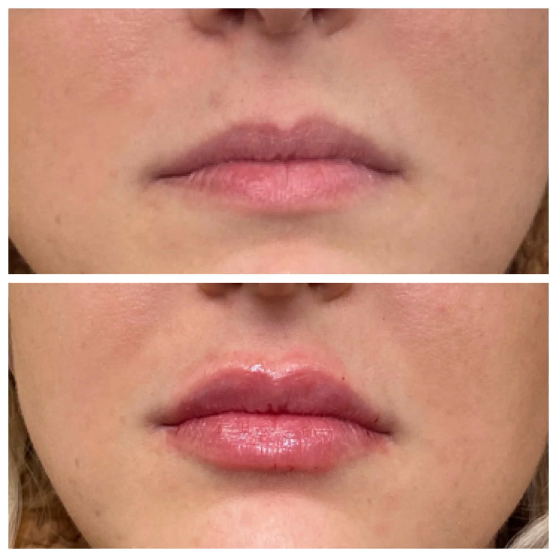 Before and After Image: Lip Filler - front