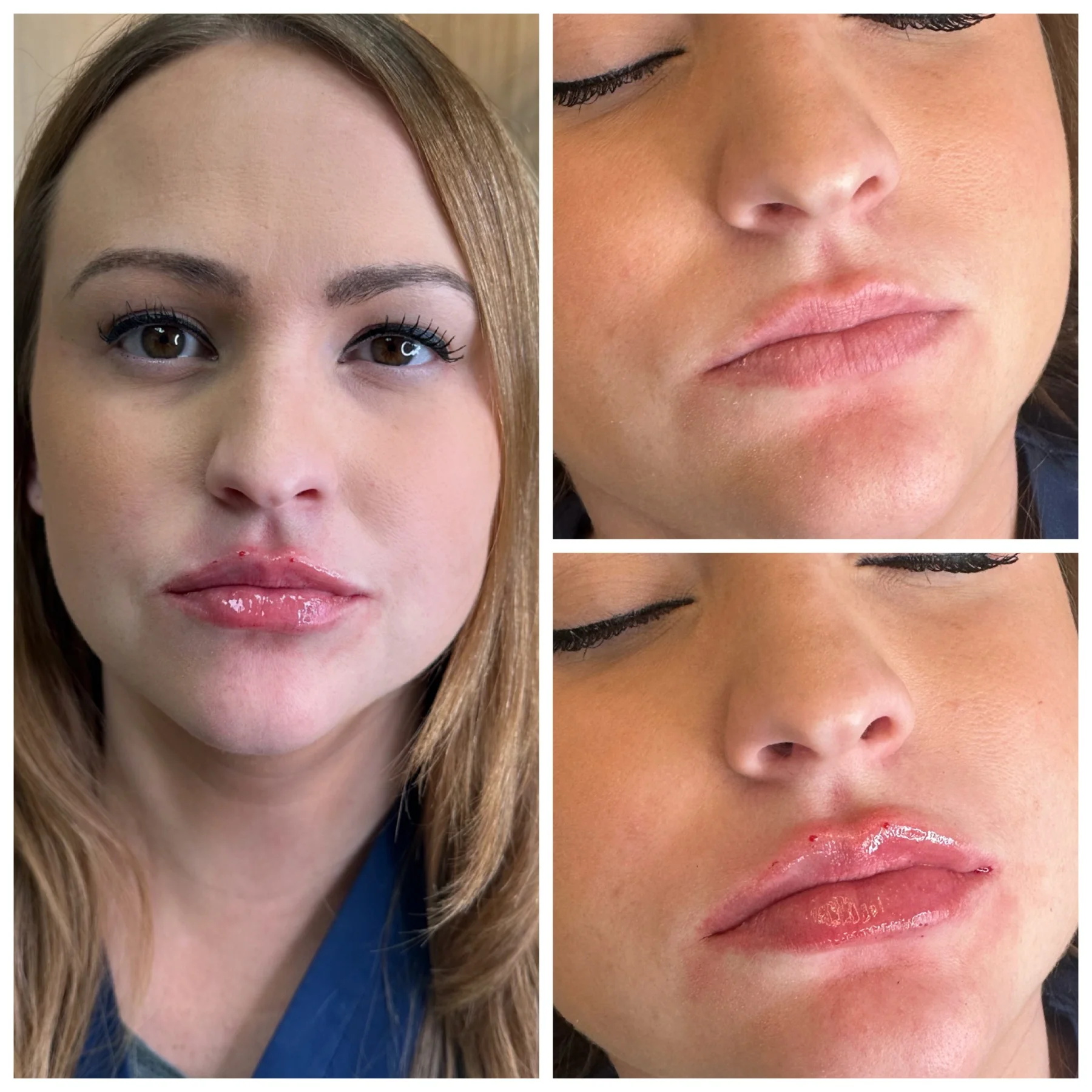 Before and After Image: Lip Filler - front
