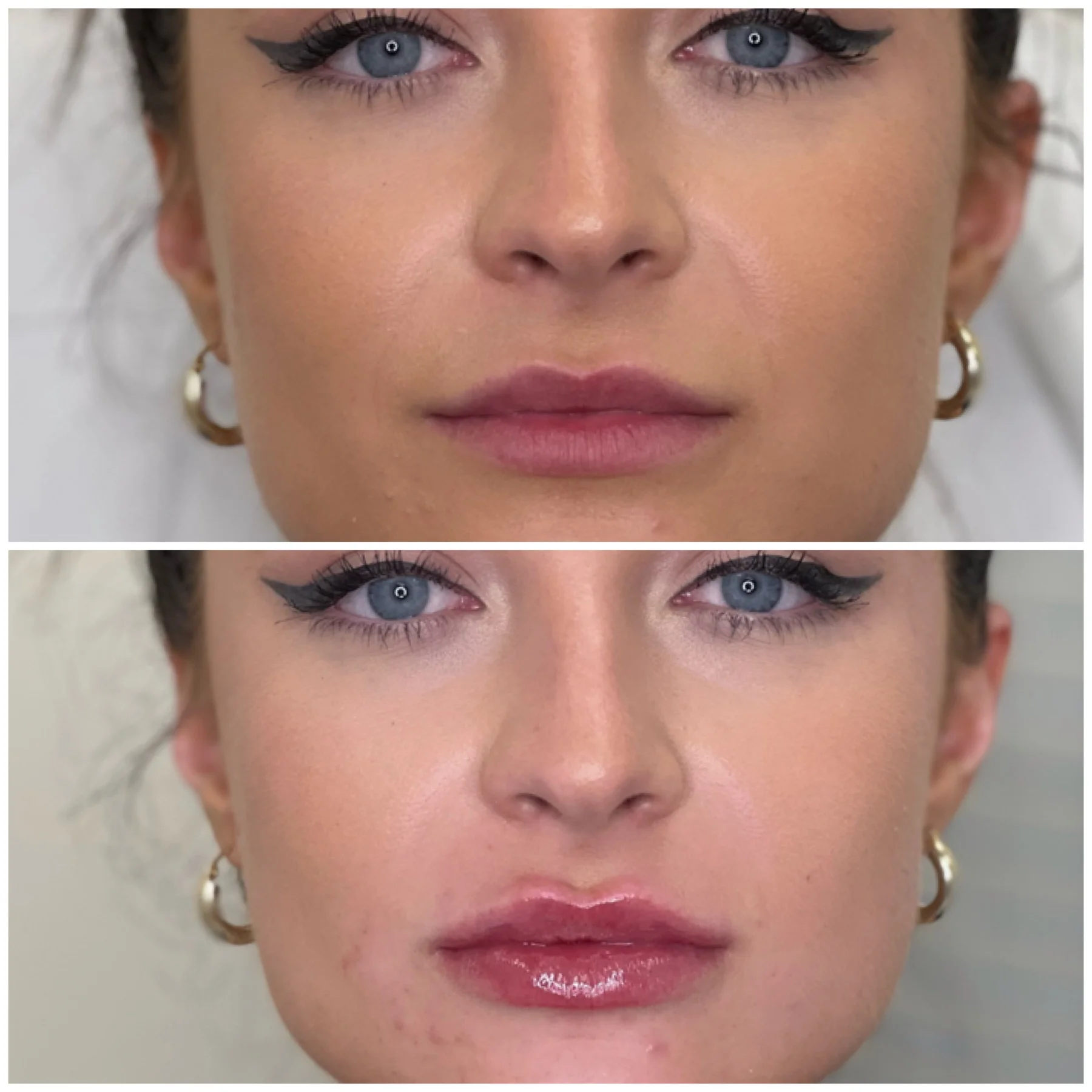 Before and After Image: Lip Filler - front