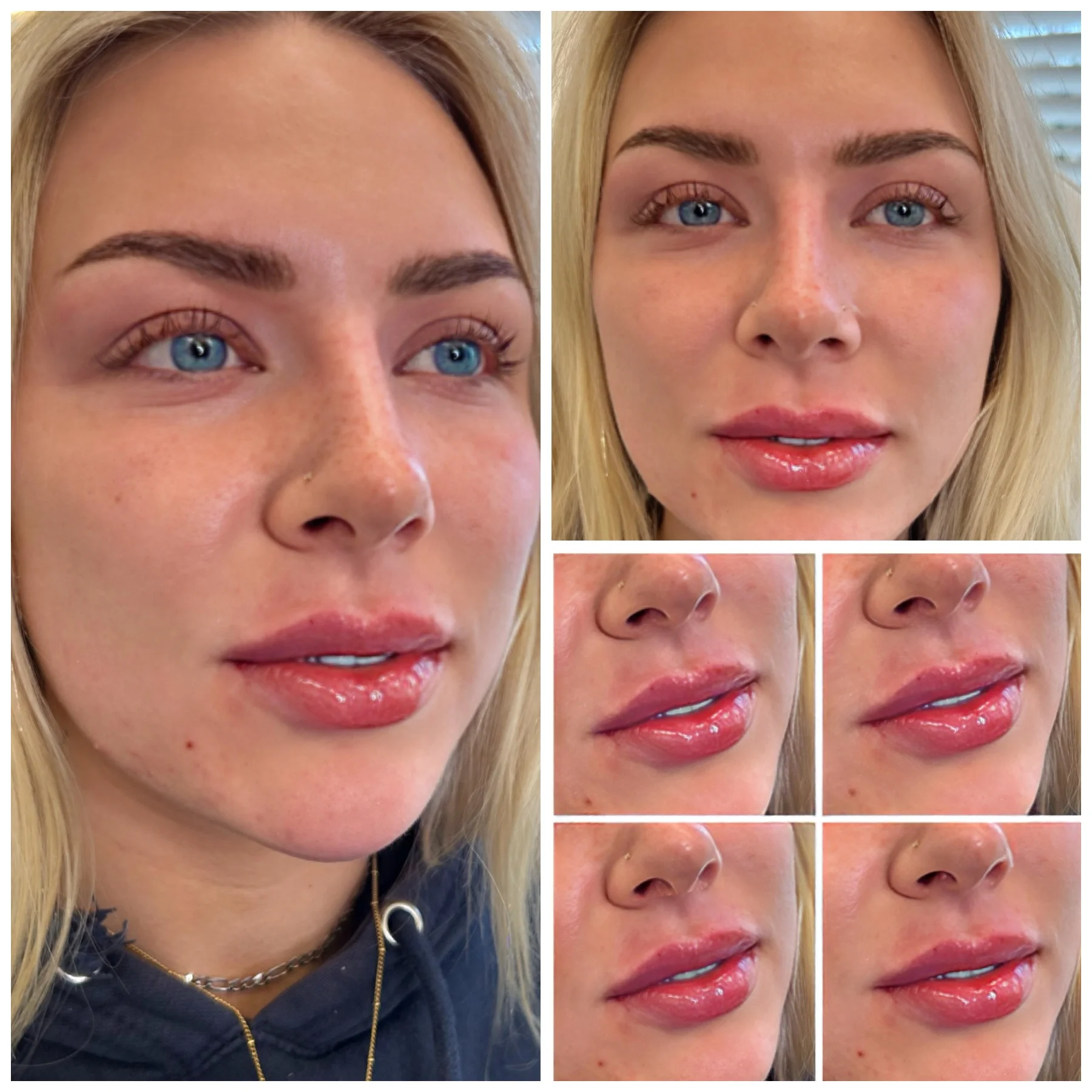 Before and After Image: Lip Filler - front