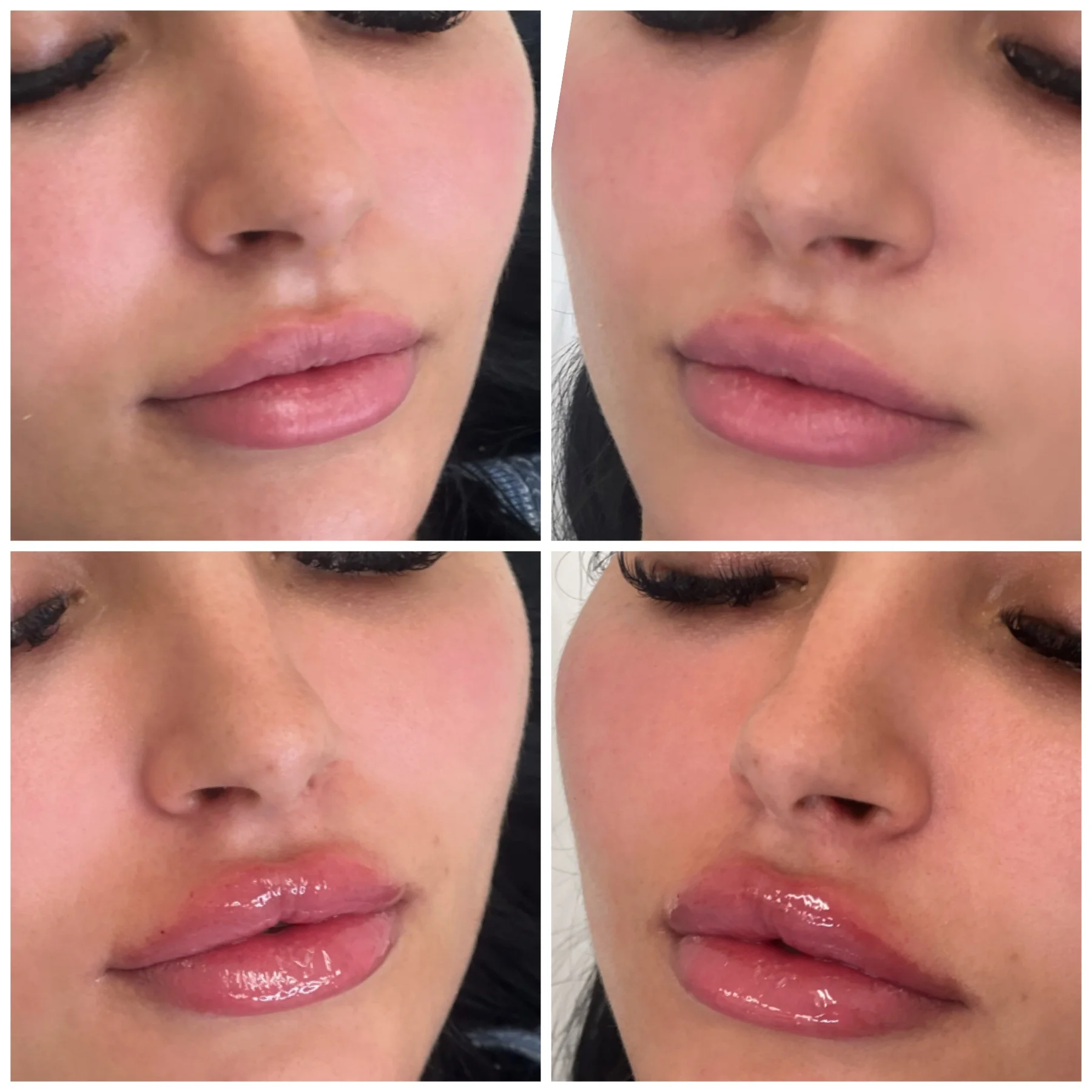 Before and After Image: Lip Filler - front