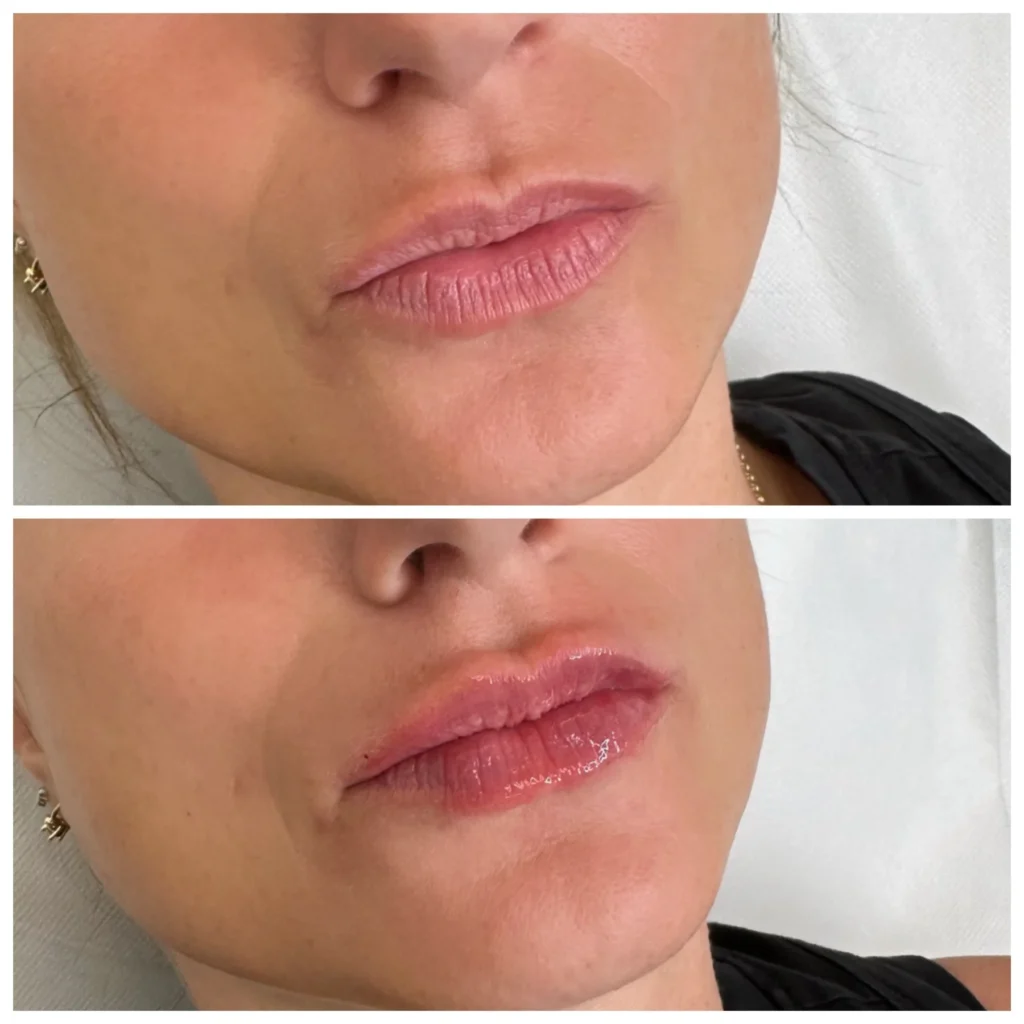 Before and After Image: Lip Filler - right-front-oblique