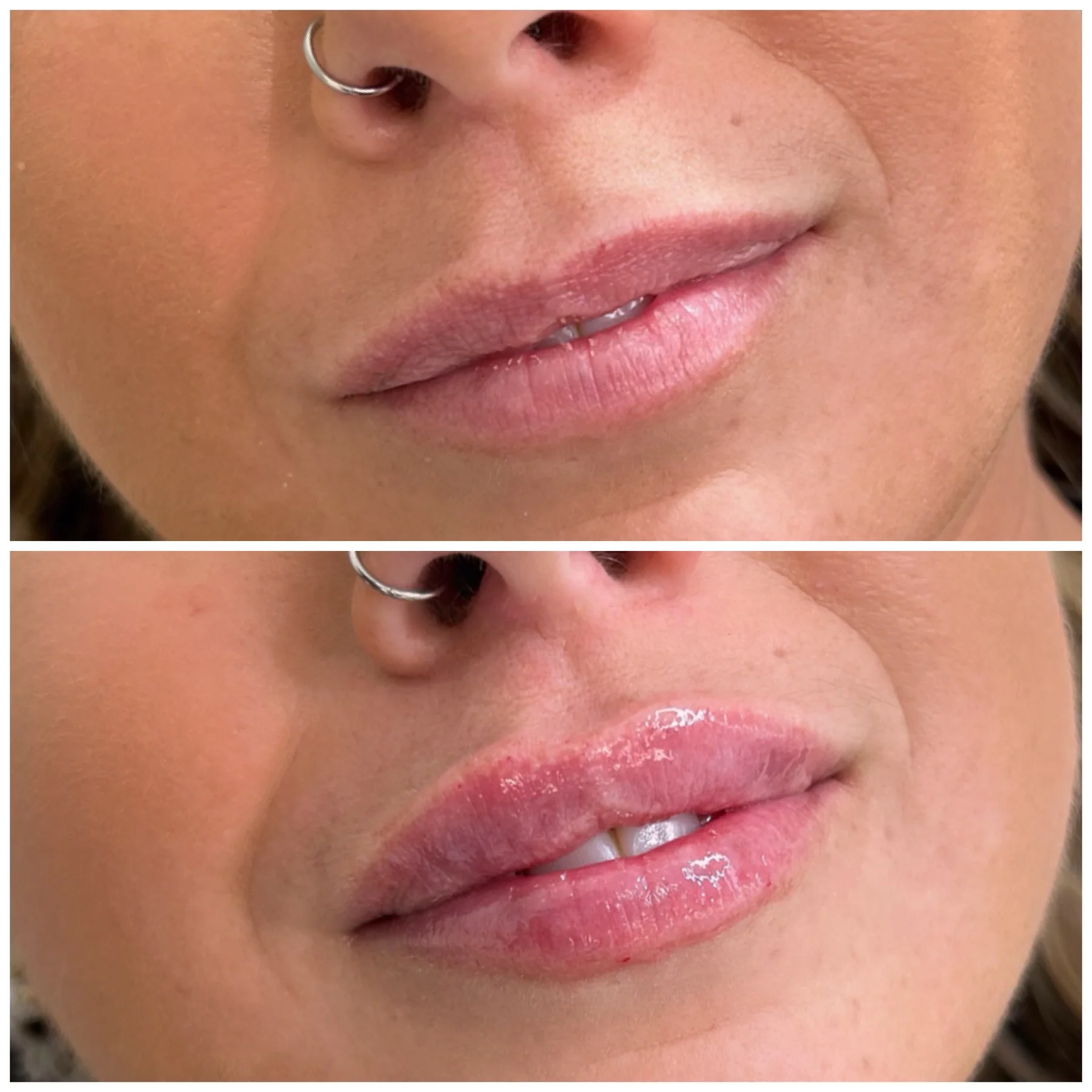 Before and After Image: Lip Filler - right-front-oblique