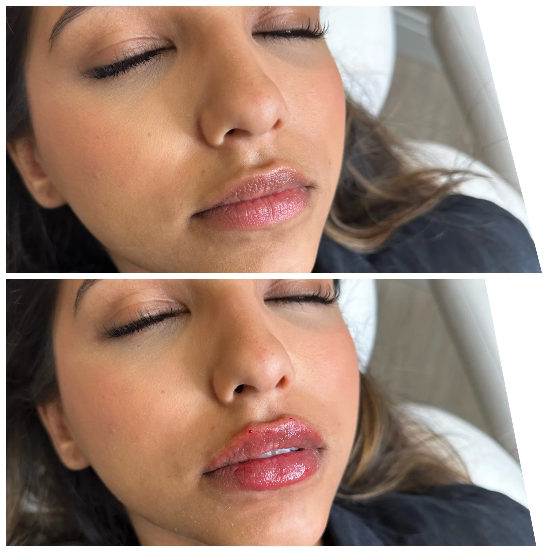 Before and After Image: Lip Filler - right-front-oblique