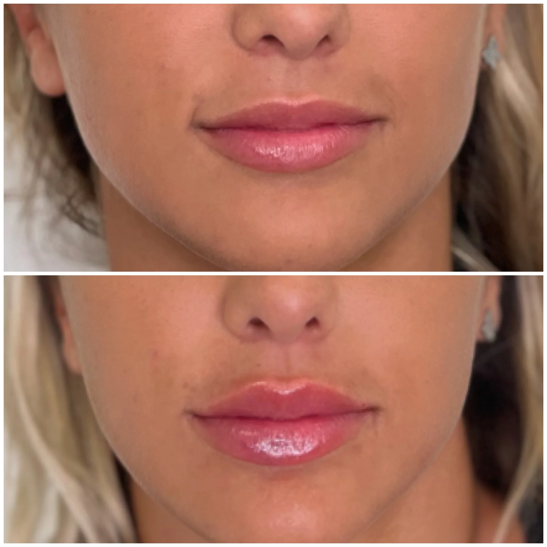 Before and After Image: Lip Filler - front