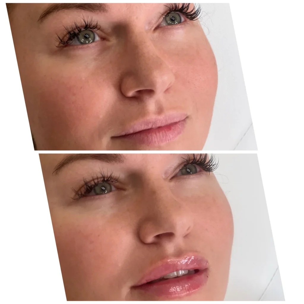 Before and After Image: Lip Filler - right-front-oblique