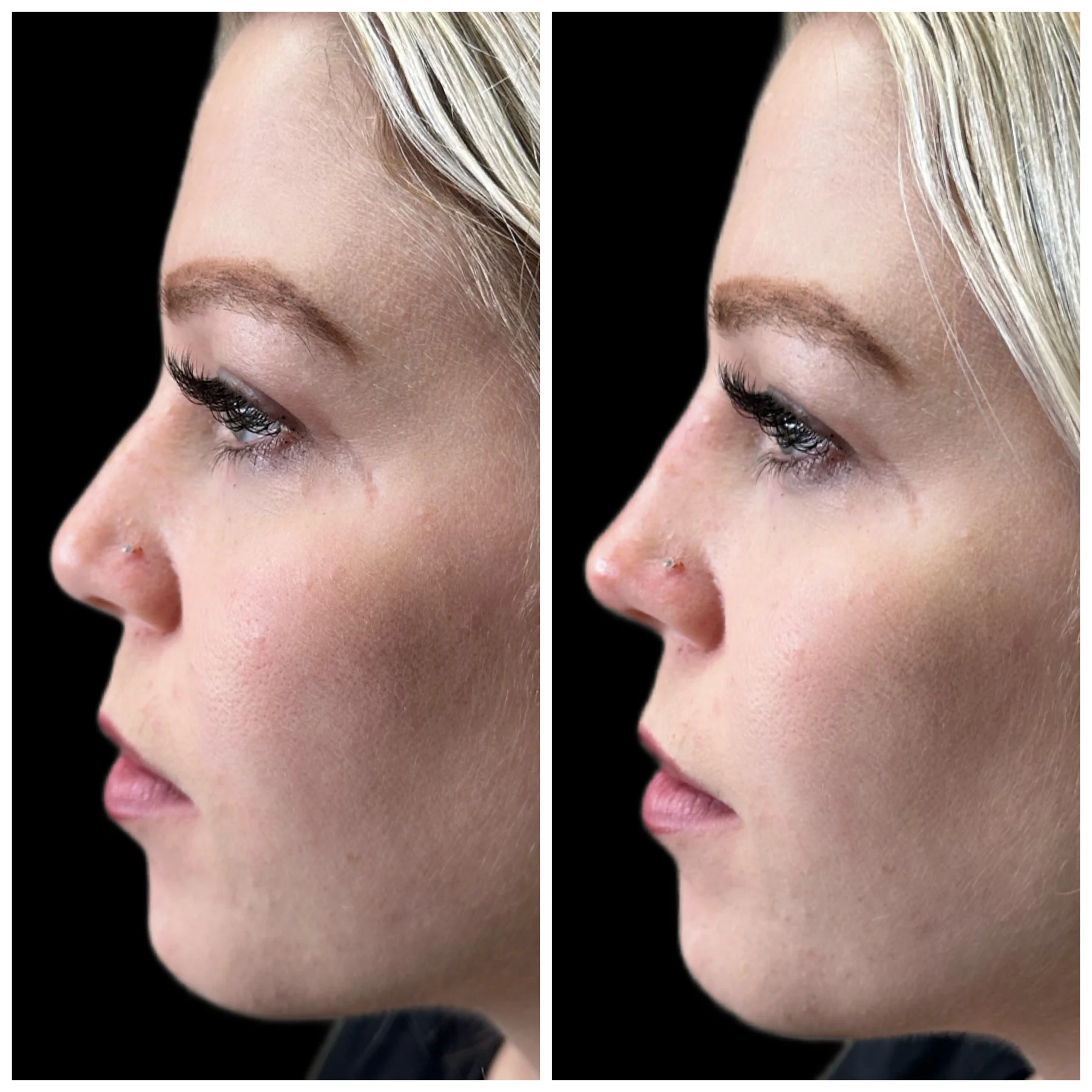 Before and After Image: Liquid Rhinoplasty with Filler - left-side