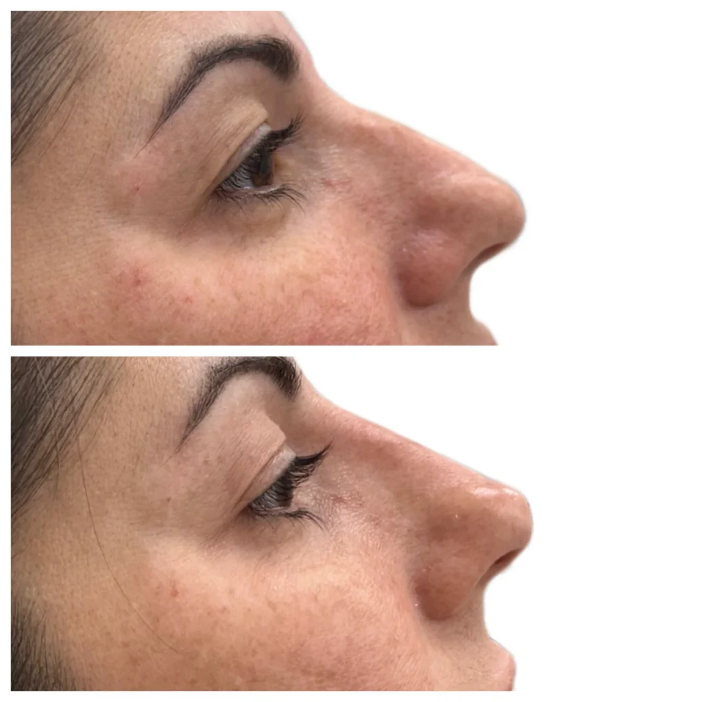 Before and After Image: Liquid Rhinoplasty with Filler - right-side