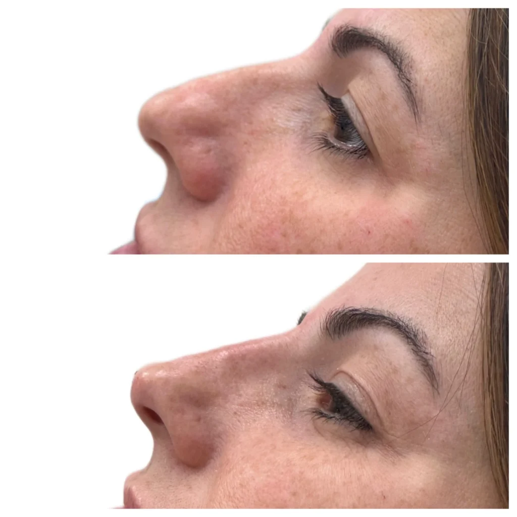 Before and After Image: Liquid Rhinoplasty with Filler - left-side