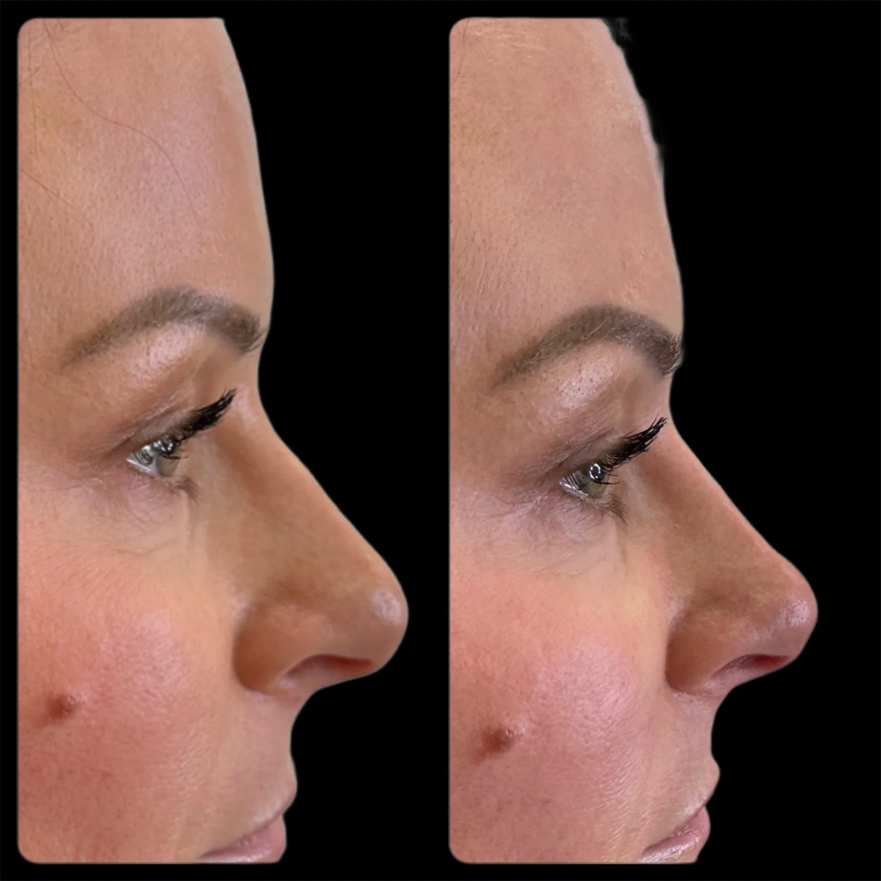 Before and After Image: Liquid Rhinoplasty with Filler - front