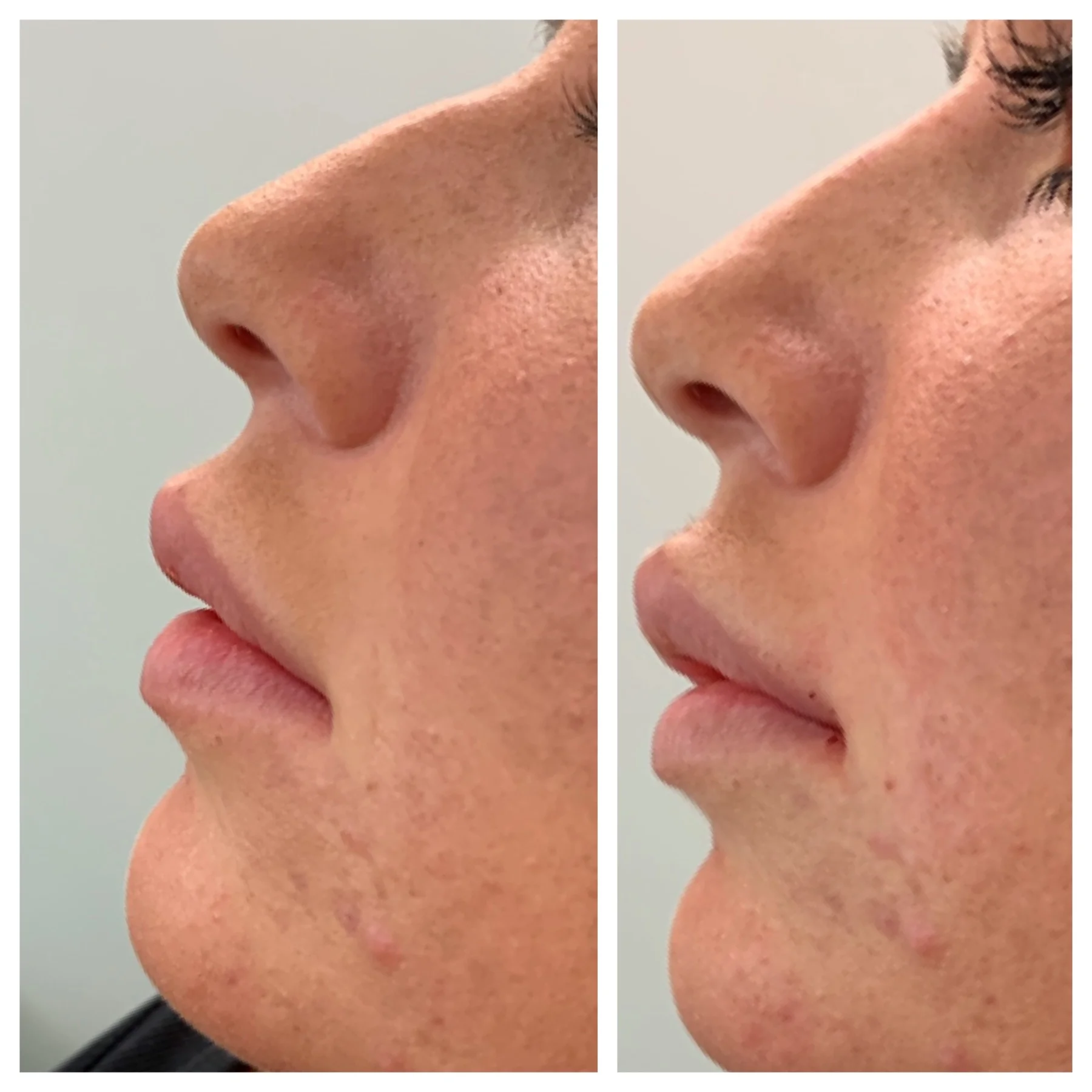 Before and After Image: Liquid Rhinoplasty with Filler - left-side