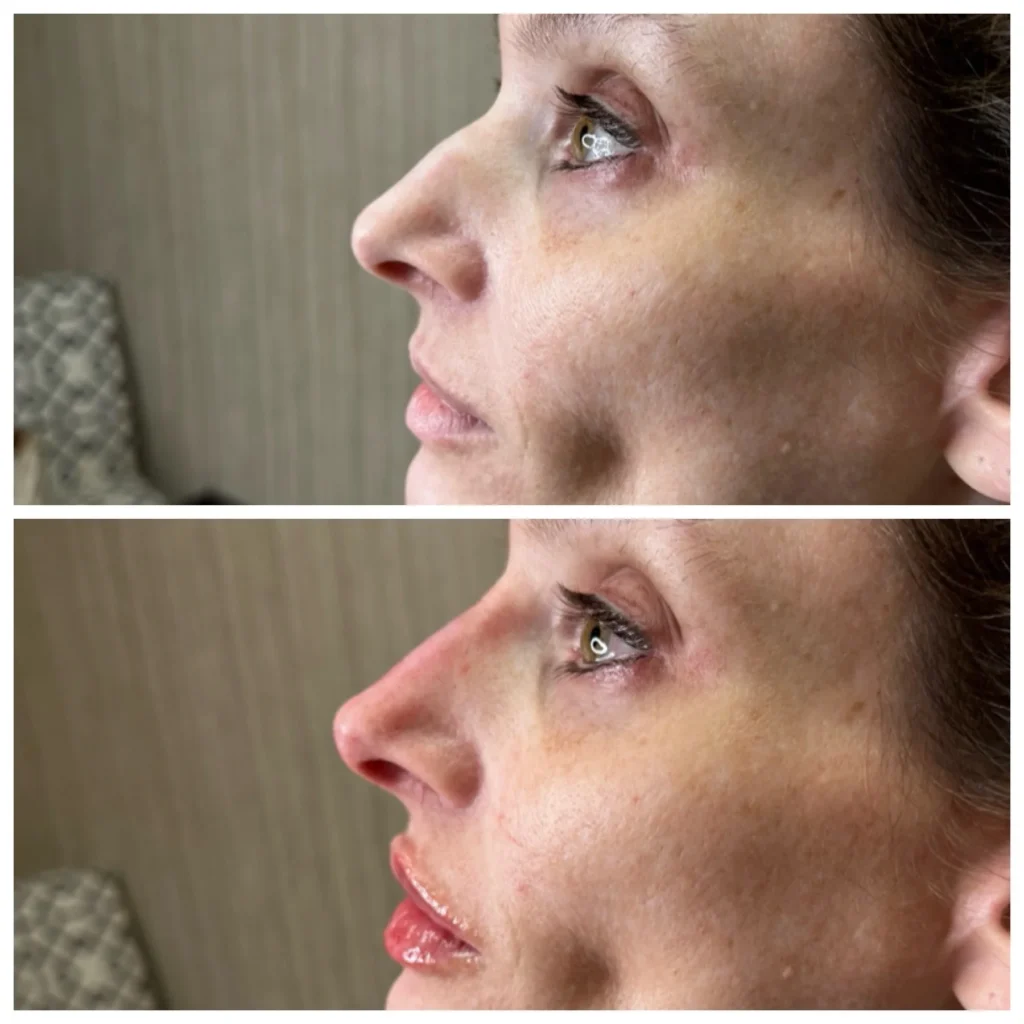 Before and After Image: Liquid Rhinoplasty with Filler - front